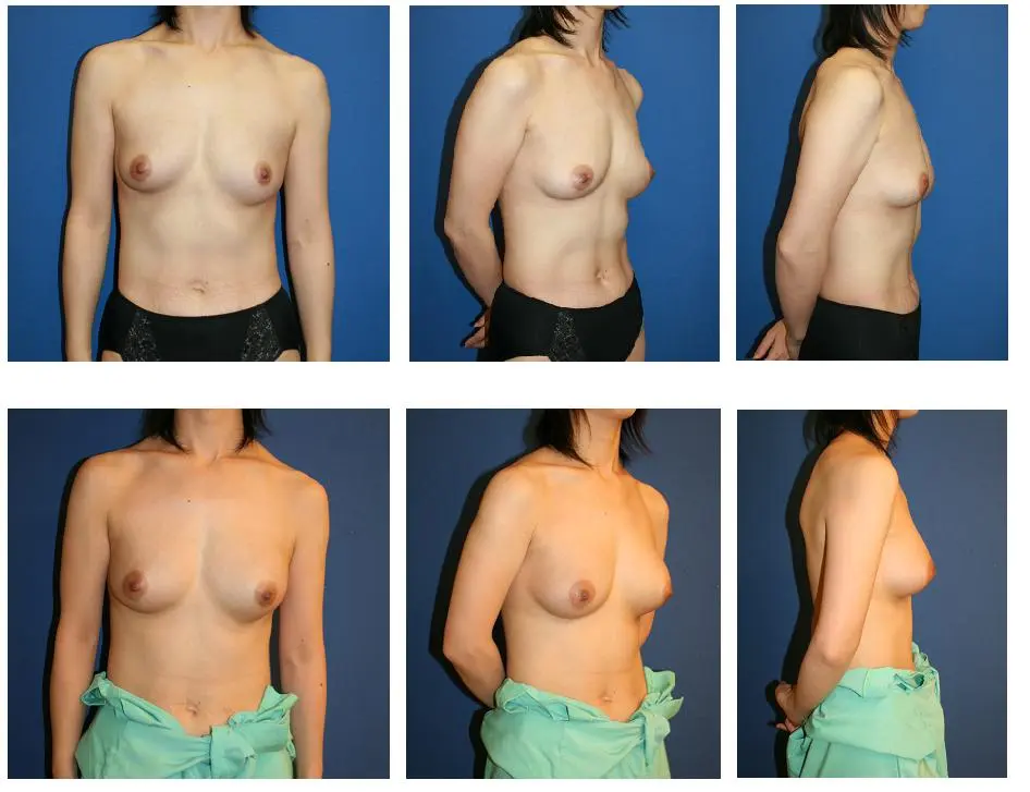 豊胸前と豊胸後のオッパイの整形画像を集めてみたわｗｗｗこれはビックリ仰天！！！001