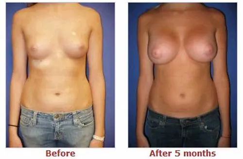 豊胸前と豊胸後のオッパイの整形画像を集めてみたわｗｗｗこれはビックリ仰天！！！007