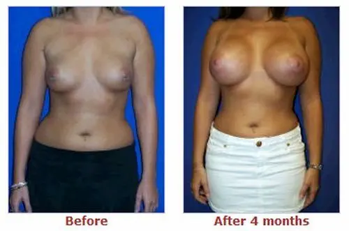 豊胸前と豊胸後のオッパイの整形画像を集めてみたわｗｗｗこれはビックリ仰天！！！008