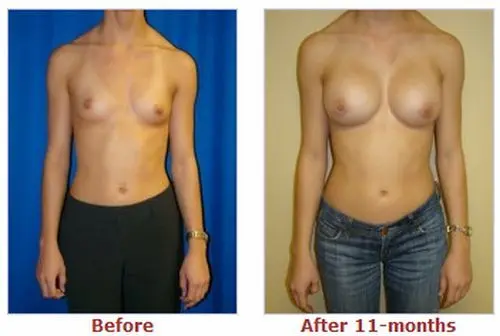 豊胸前と豊胸後のオッパイの整形画像を集めてみたわｗｗｗこれはビックリ仰天！！！011