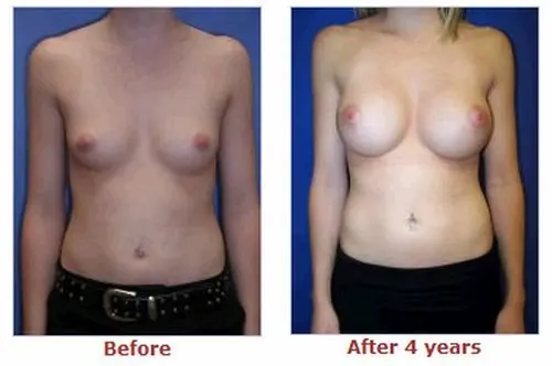 豊胸前と豊胸後のオッパイの整形画像を集めてみたわｗｗｗこれはビックリ仰天！！！012