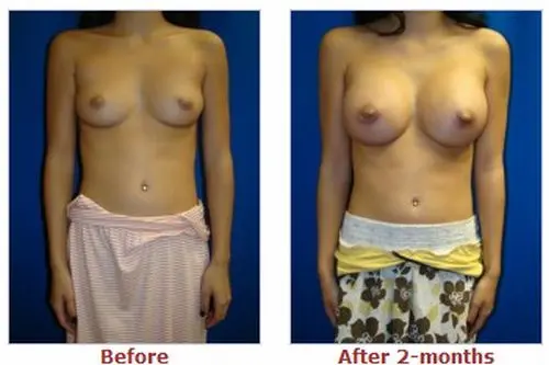 豊胸前と豊胸後のオッパイの整形画像を集めてみたわｗｗｗこれはビックリ仰天！！！013