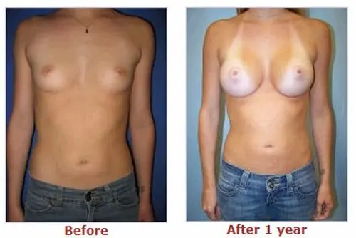 豊胸前と豊胸後のオッパイの整形画像を集めてみたわｗｗｗこれはビックリ仰天！！！014