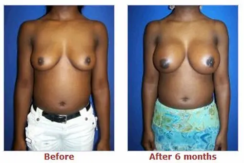 豊胸前と豊胸後のオッパイの整形画像を集めてみたわｗｗｗこれはビックリ仰天！！！015