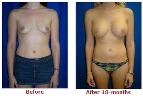 豊胸前と豊胸後のオッパイの整形画像を集めてみたわｗｗｗこれはビックリ仰天！！！016