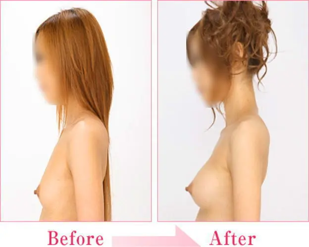 豊胸前と豊胸後のオッパイの整形画像を集めてみたわｗｗｗこれはビックリ仰天！！！020