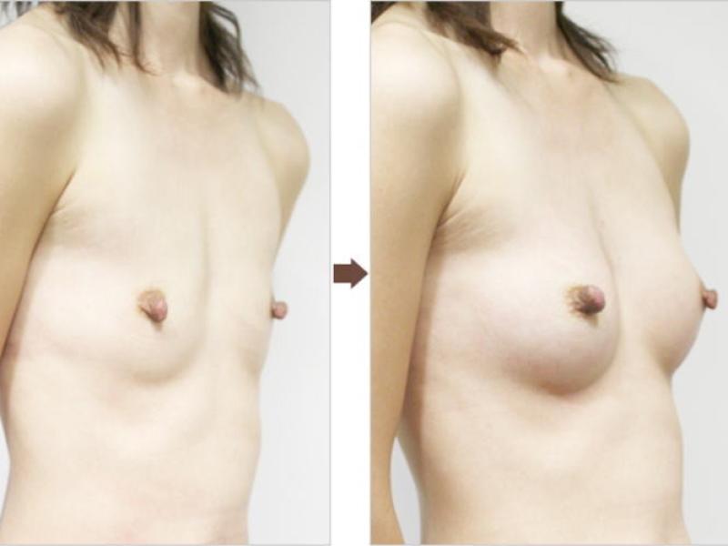 豊胸前と豊胸後のオッパイの整形画像を集めてみたわｗｗｗこれはビックリ仰天！！！のサムネイル